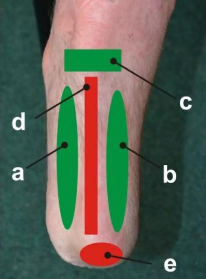 TACTILUS 柔性压力分布系统应用于假肢研究中