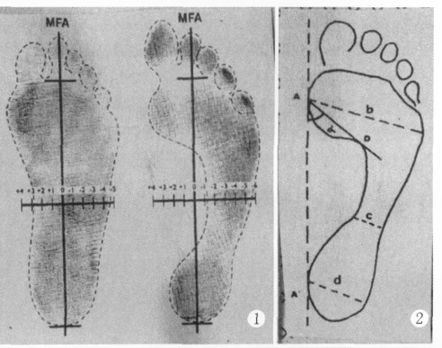 扁平足足印的测量与临床研究现状 扁平足足印的测量与临床研究现状